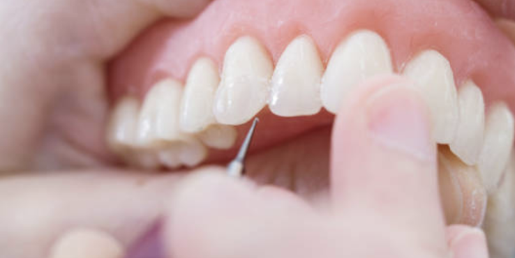 leczenie ubytków zębowych